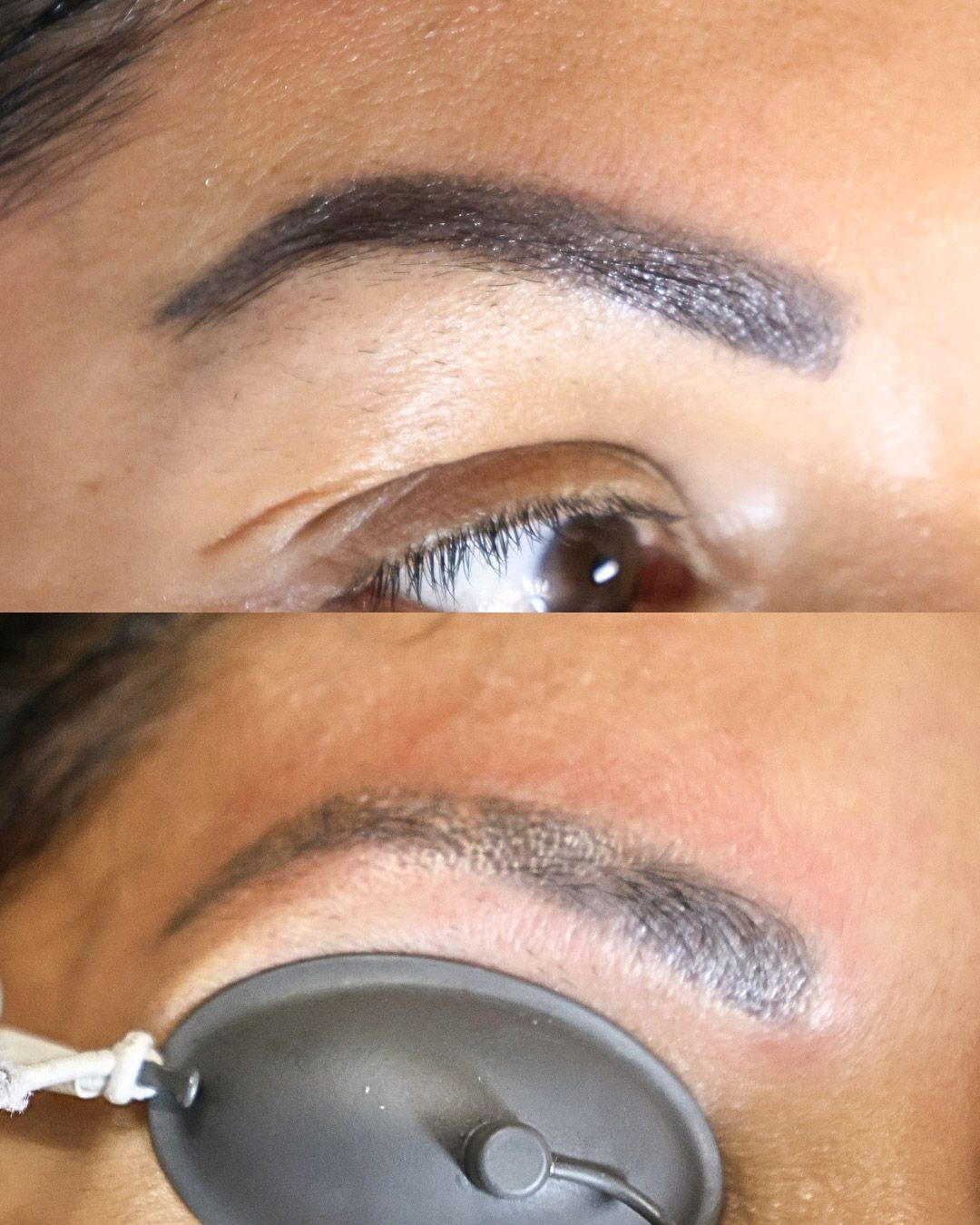 Avant / après détatouage des sourcils au laser picoseconde