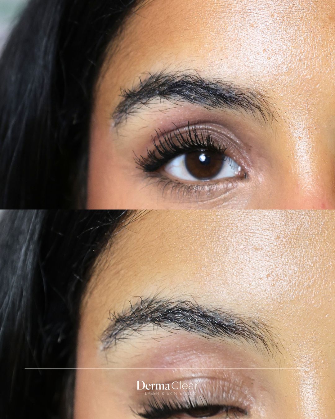 Avant / après détatouage des sourcils – Dermaclear Genève