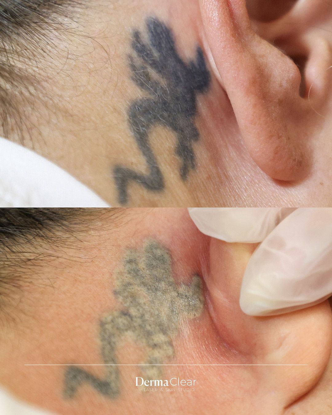 Avant / après détatouage laser picoseconde derrière l’oreille – Dermaclear Genève